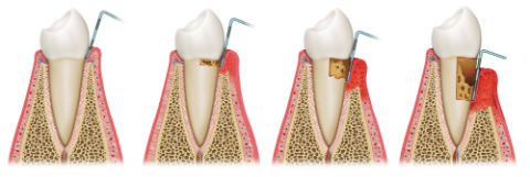 Gum Disease Treatment | Dr. Ly | Divine Dental Solutions | Dentist Elk Grove, CA