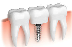 Dental Implants | Divine Dental Solutions | Dentist Fresno, CA