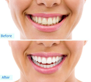 Teeth Whitening | Divine Dental Solutions | Sacramento, CA Dentist
